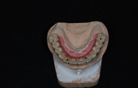PROTESI TORONTO BRIDGE in Zirconia e Ceramica Stratificata