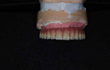PROTESI TORONTO BRIDGE in Zirconia e Ceramica Stratificata