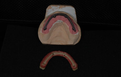 PROTESI TORONTO BRIDGE in Zirconia e Ceramica Stratificata