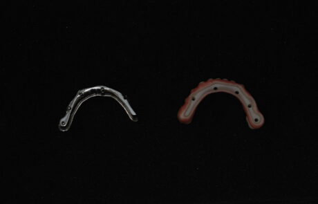 PROTESI TORONTO BRIDGE in Zirconia e Ceramica Stratificata