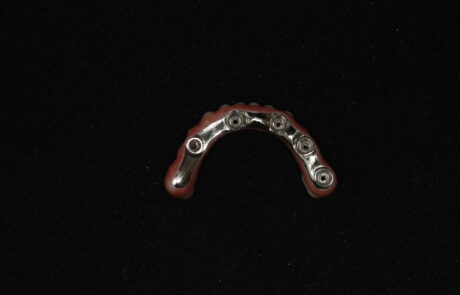 PROTESI TORONTO BRIDGE in Zirconia e Ceramica Stratificata